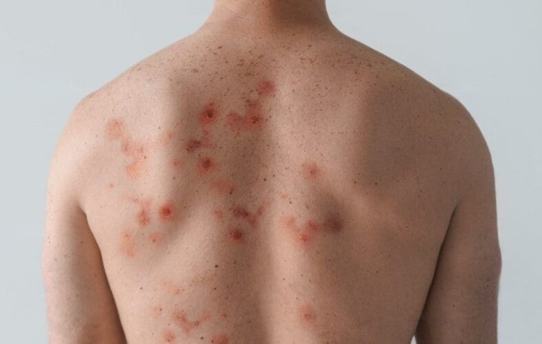 Spanje heeft twee doden door apenpokken gemeld met 4.300 besmette personen